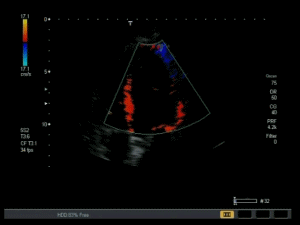 Tissue doppler in der Echokardiographie